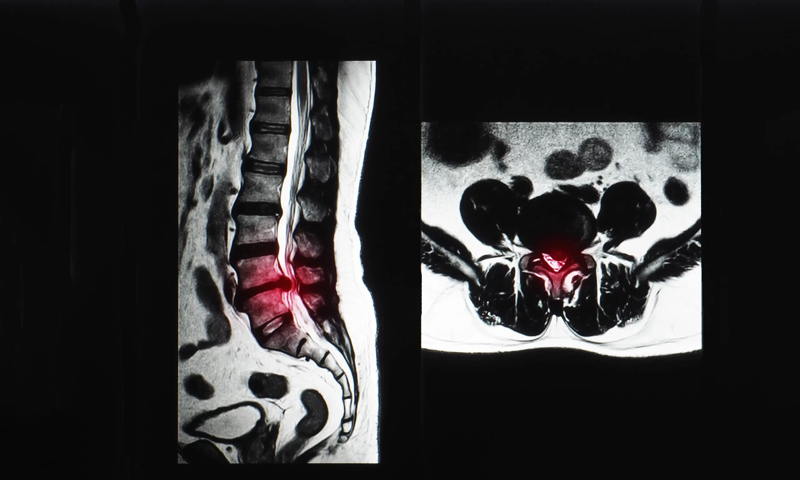 Bel Fıtığında Tanı Nasıl Konur