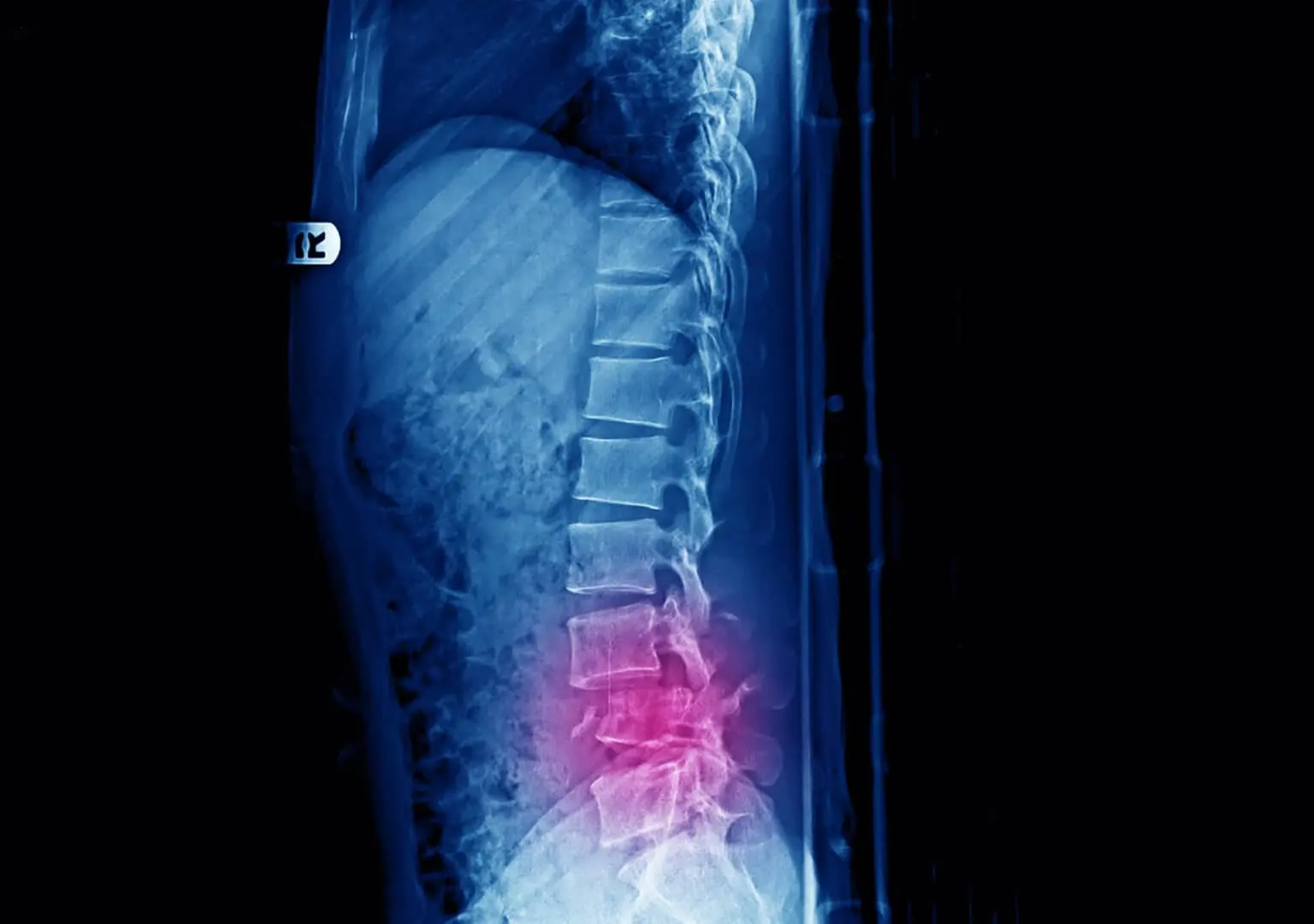 Causes of Spine Fracture