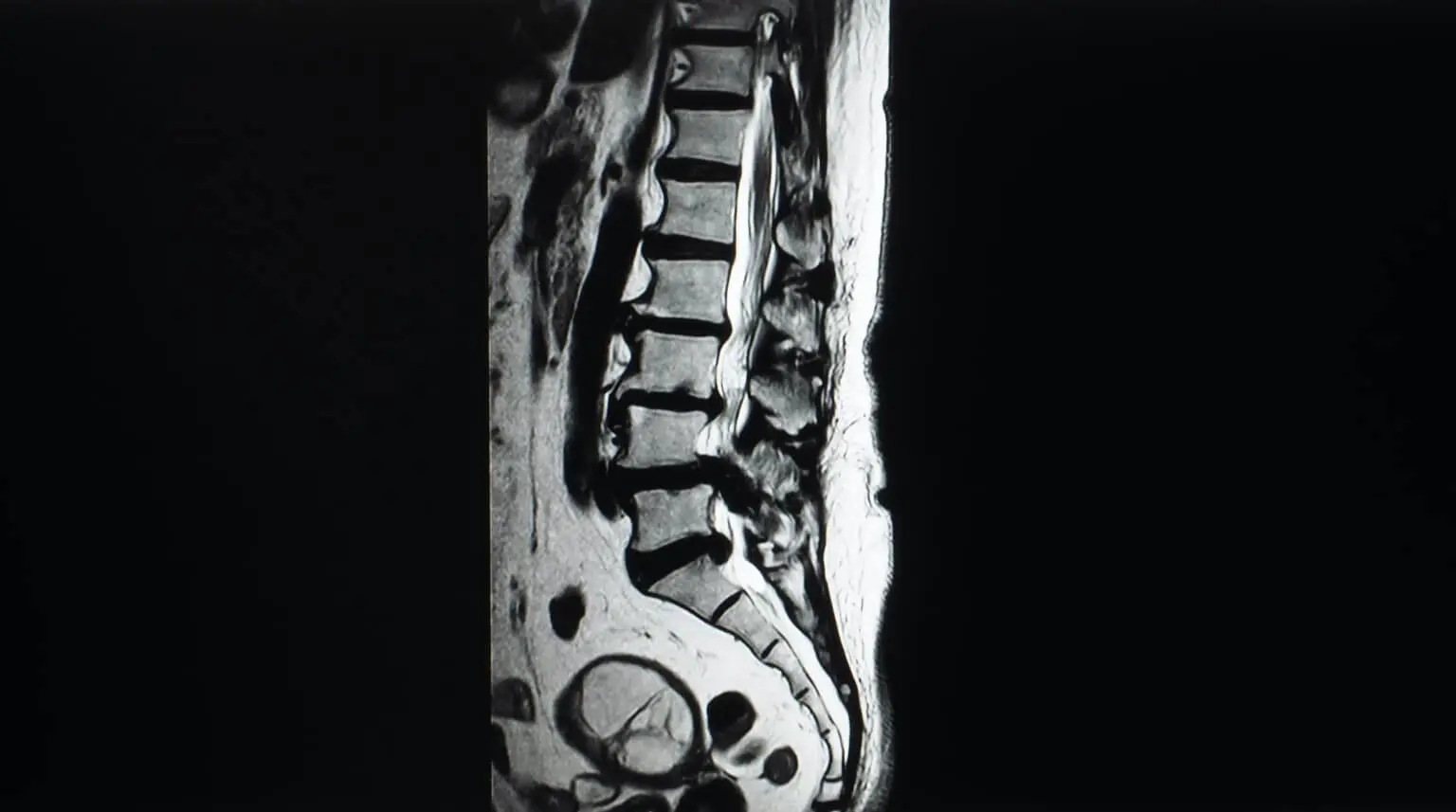 How Is Spinal Cord Canal Narrowing Diagnosed?