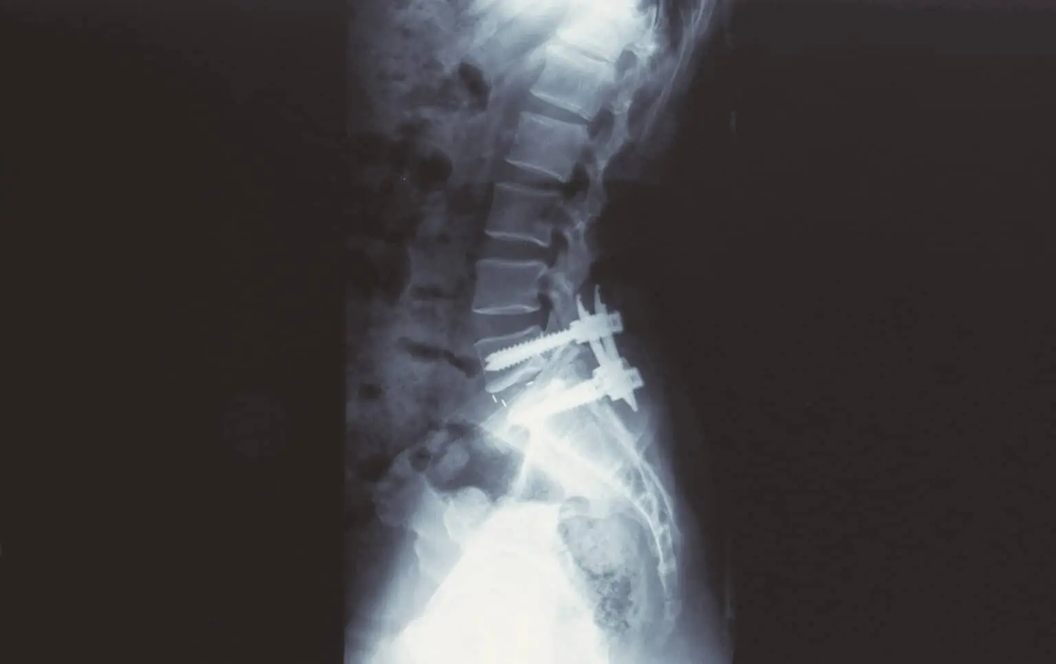 How is Lumbar Sprain Treated?