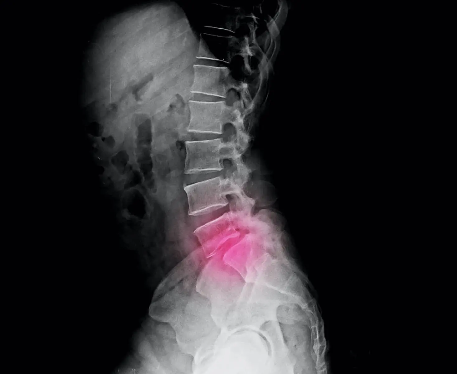 What Are the Types of Lumbar Sprain?