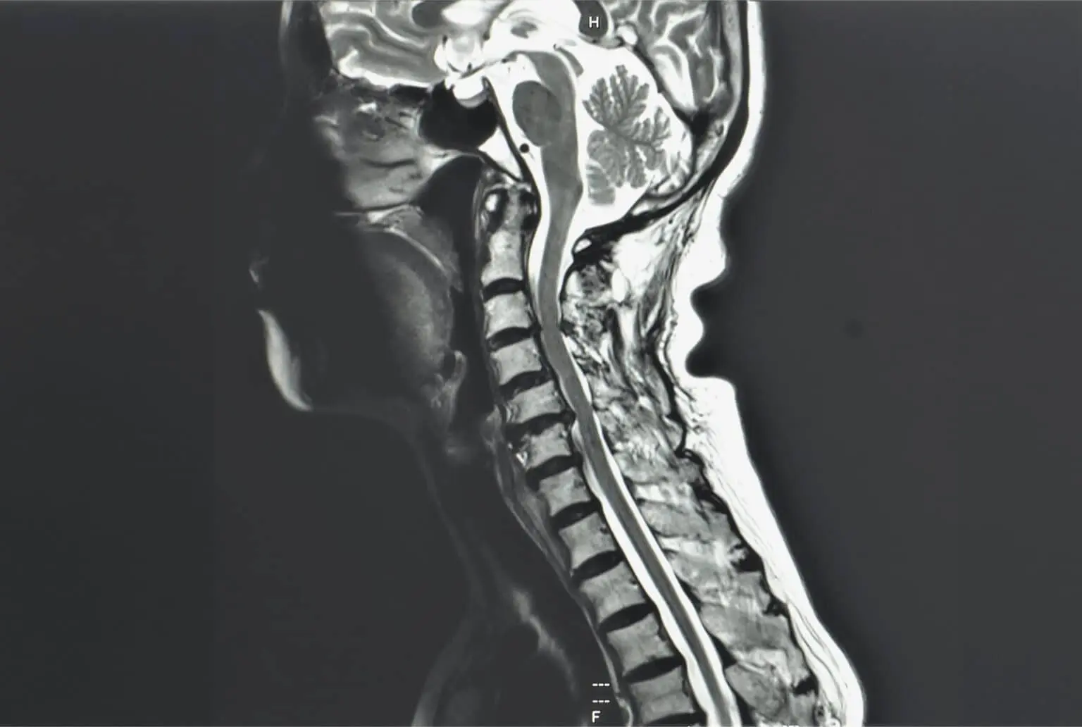 What is Cervical Hernia?