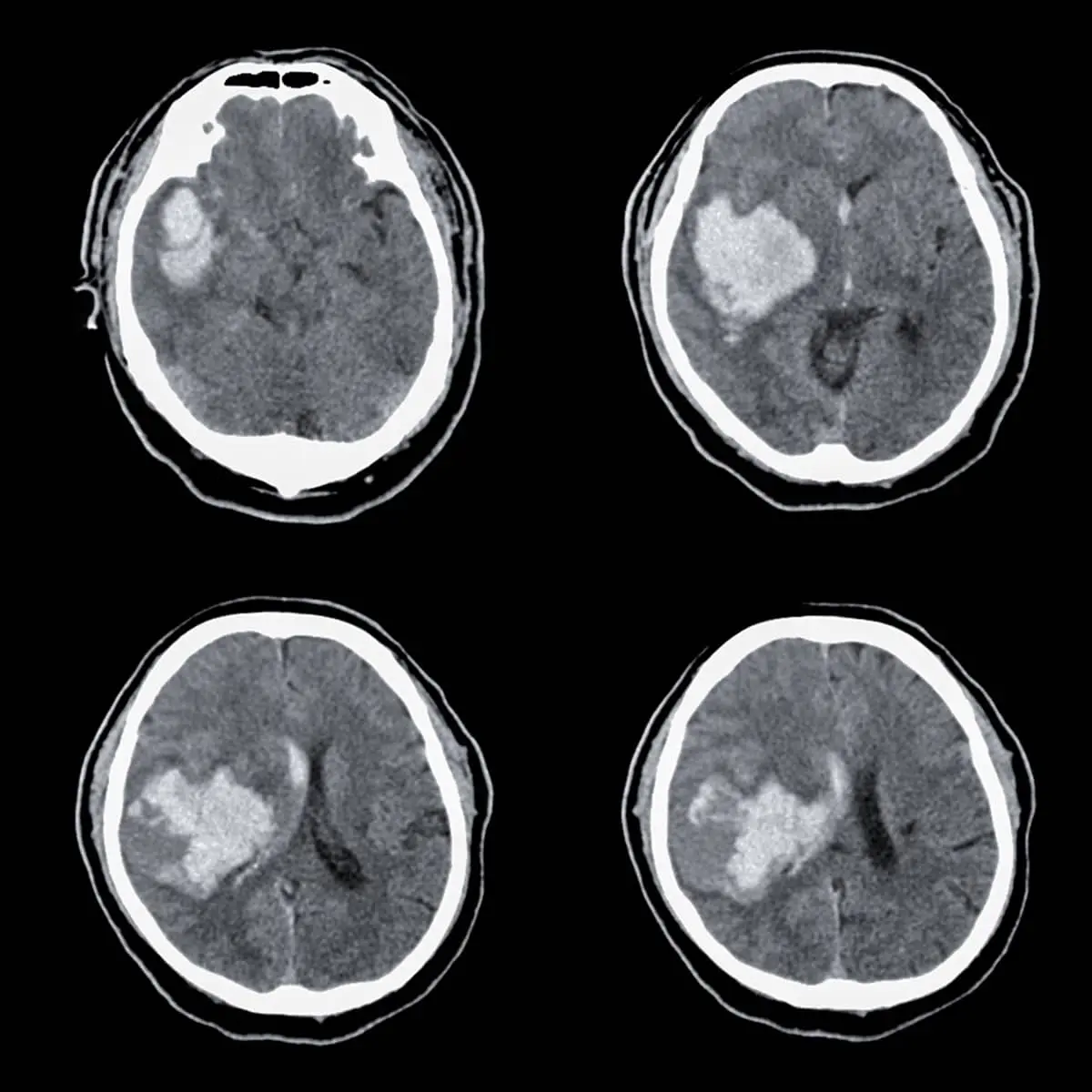What is a Brain Hemorrhage?