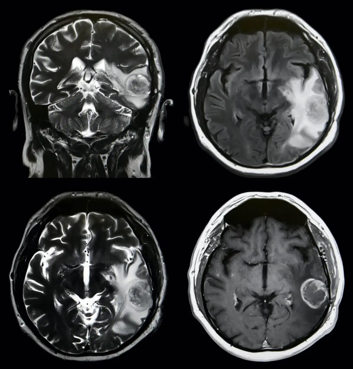 What is the Brain Tumor?