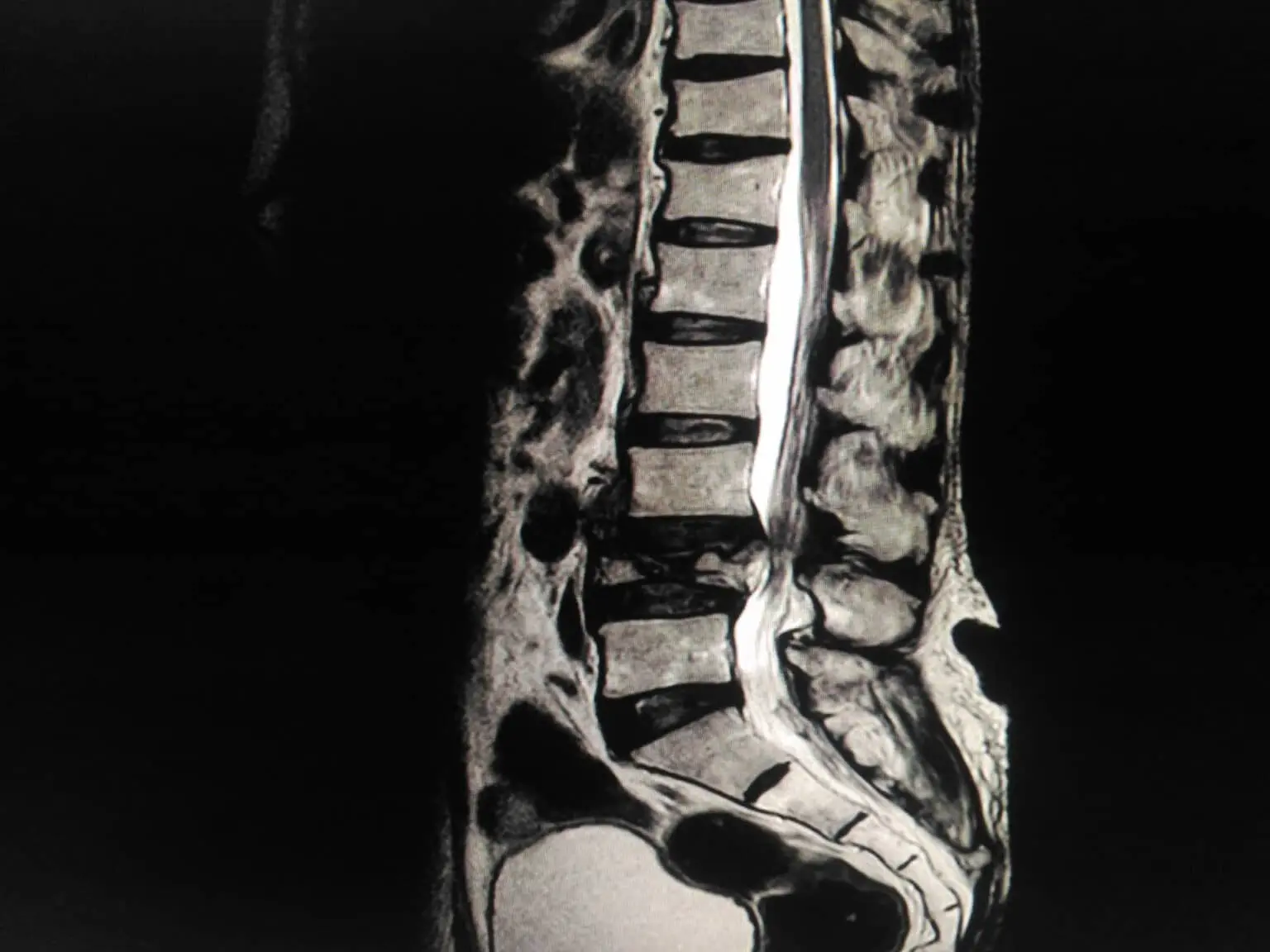 What is a Spine Fracture?
