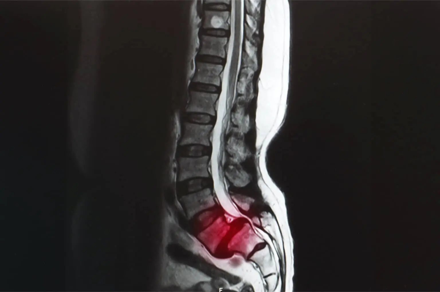 What is lumbar sprain